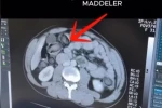 Mideye gizlenen uyuşturucu Erzincan’da ele geçirildi 