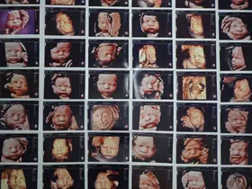 7 yıllık bebek hasreti "kişiye özel" tedaviyle son buldu
