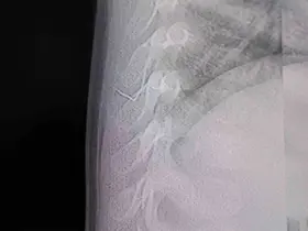 Bebeğin sırtından tel parçası çıktı
