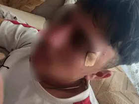 Öğretmenin kafa attığı çocuğun burnu kırıldı
