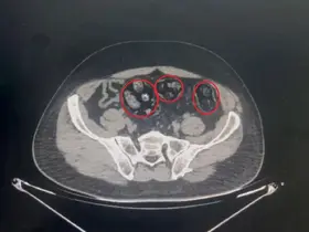 Yolcunun midesinden 62 parça uyuşturucu çıktı
