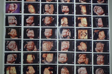 7 yıllık bebek hasreti "kişiye özel" tedaviyle son buldu 