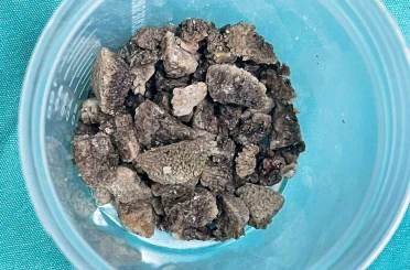 8 santimetrelik ’geyik boynuzu’ böbrek taşı kapalı yöntemle çıkarıldı 