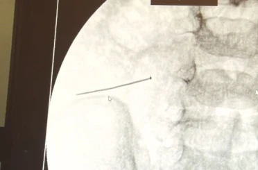 Ağrıyla kıvranan 2 yaşındaki çocuğun bağırsağından 3 santimlik iğne çıktı 