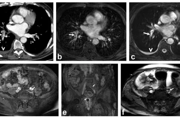 Akciğer damarındaki pıhtıların tanısında radyasyonsuz çözüm 