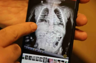 Doğuştan 200 binde bir görülen hastalıkla 2 yıl boyunca yaşayan çocuk sağlığına kavuştu 