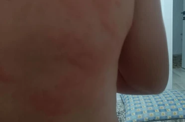 Elazığ’da böcek ısırığı hastanelik etti 