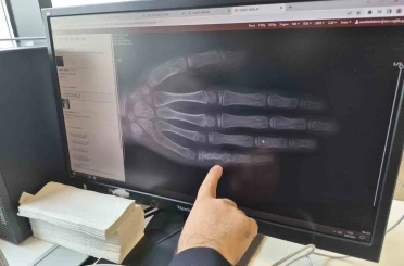 Eskişehir’de her ay 5 ila 7 çocuğa kanser tanısı konuluyor 