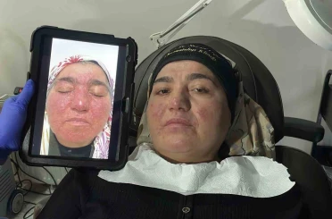 Hastalığı yüzünden yıllarca evden çıkamadı, şimdi ise çekinmeden çıkabiliyor 