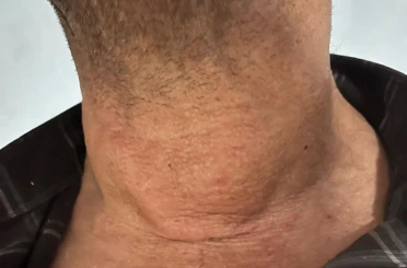 Kütahya’da dev guatr ameliyatsız tedavi edildi: Yüzde 90’dan fazla küçülme oldu 