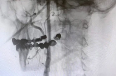 Manisa Şehir Hastanesi’nde felç riskine karşı ameliyatsız çözüm 