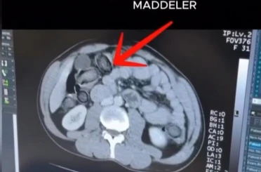 Mideye gizlenen uyuşturucu Erzincan’da ele geçirildi 