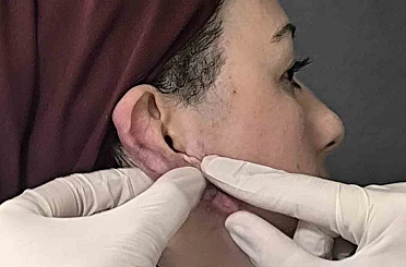 Muş’ta bir ilk: Kulak keloidi, ödüllü cerrahi teknikle tedavi edildi 