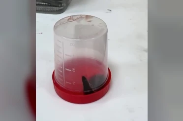 Siirt te 6 yaşındaki çocuğun boğazından sülük çıktı 