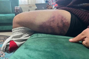 Vicdanları yaralayan olay: Otizmli şahıs odunluğa baktı diye odunla darbedildi 