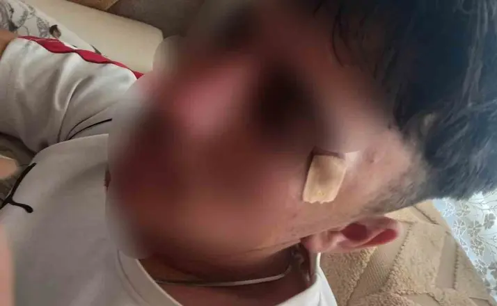 Öğretmenin kafa attığı çocuğun burnu kırıldı
