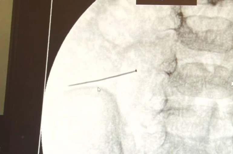 Ağrıyla kıvranan 2 yaşındaki çocuğun bağırsağından 3 santimlik iğne çıktı 