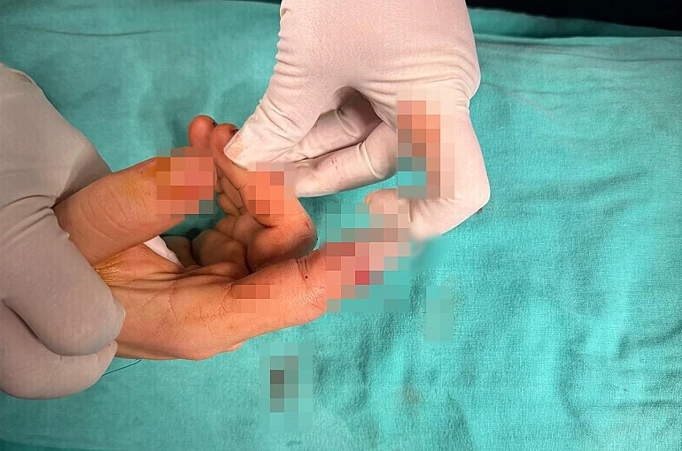 Bandırma’da asansör kazasında kopan parmak başarılı ameliyatla kurtarıldı 