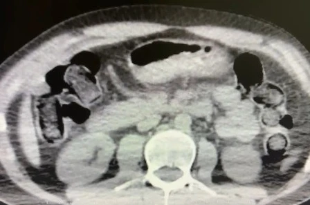 Midelerinde uyuşturucu sevkiyatı yapan 2 torbacı tutuklandı