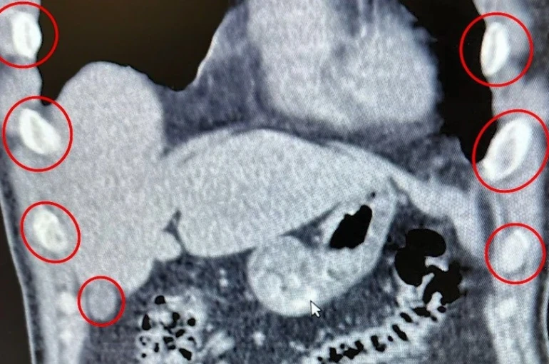 Midelerinden 136 kapsül uyuşturucu çıktı