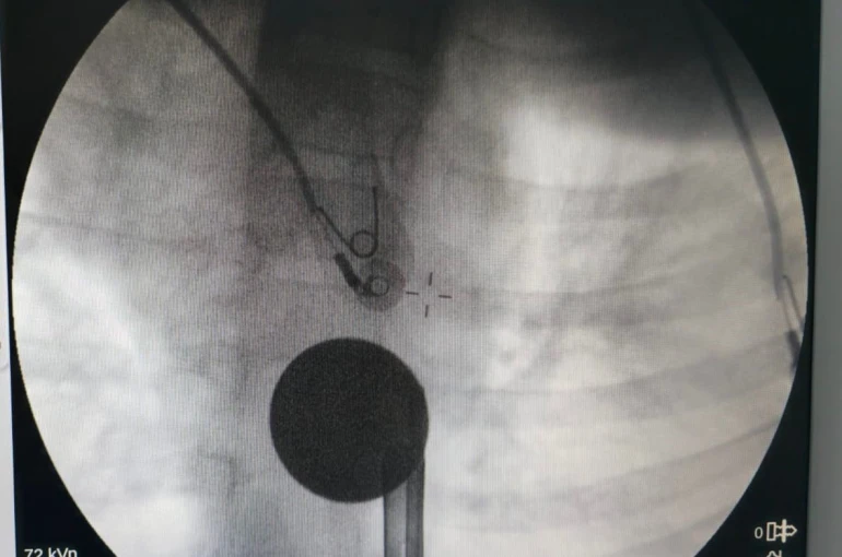 Siirt’te boğazına madeni para kaçan çocuk, doktorların müdahalesi ile kurtarıldı 