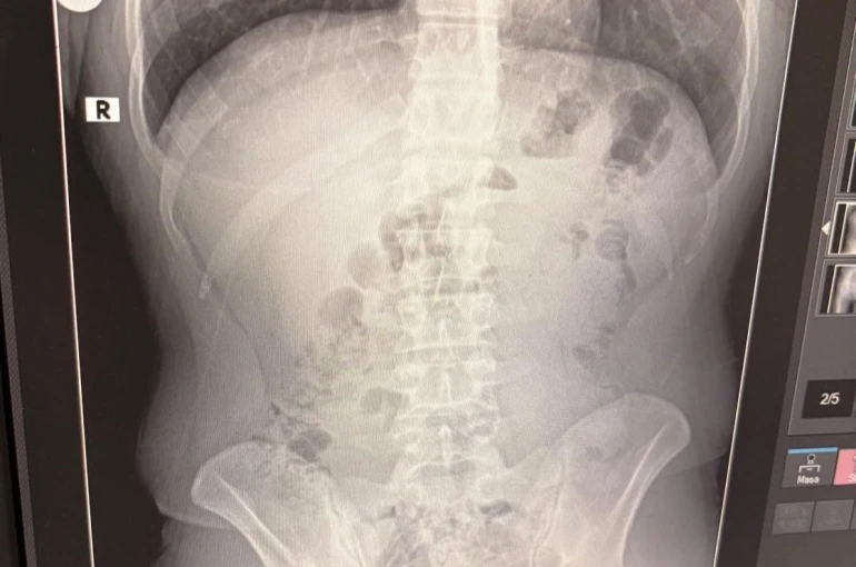 Uşak’ta midelerinden uyuşturucu çıktı: İranlı 3 kişi tutuklandı